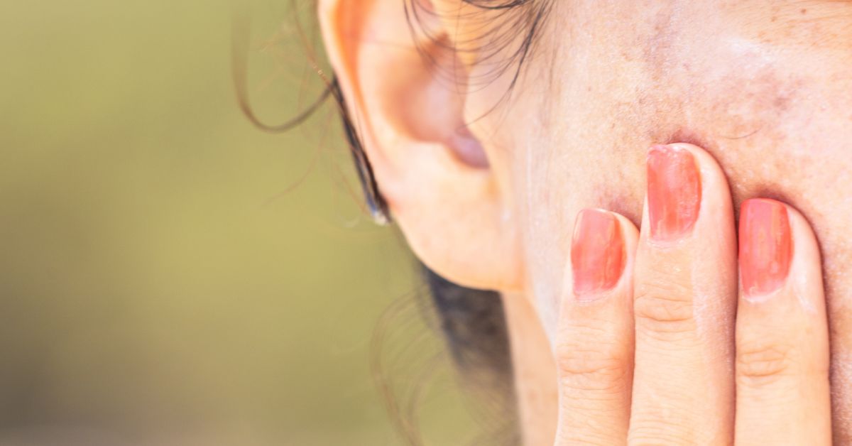 How to Remove Dark Spots on Face Fast Naturally in 12 Ways