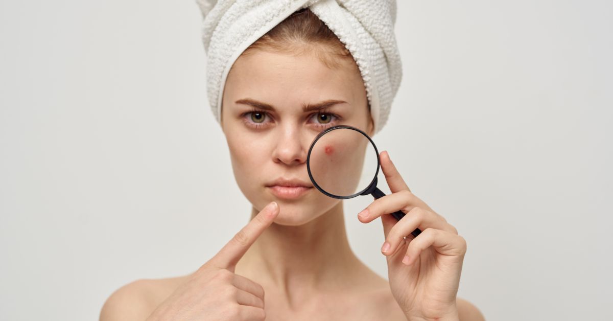 How to Reduce Acne Redness with Skincare and Makeup