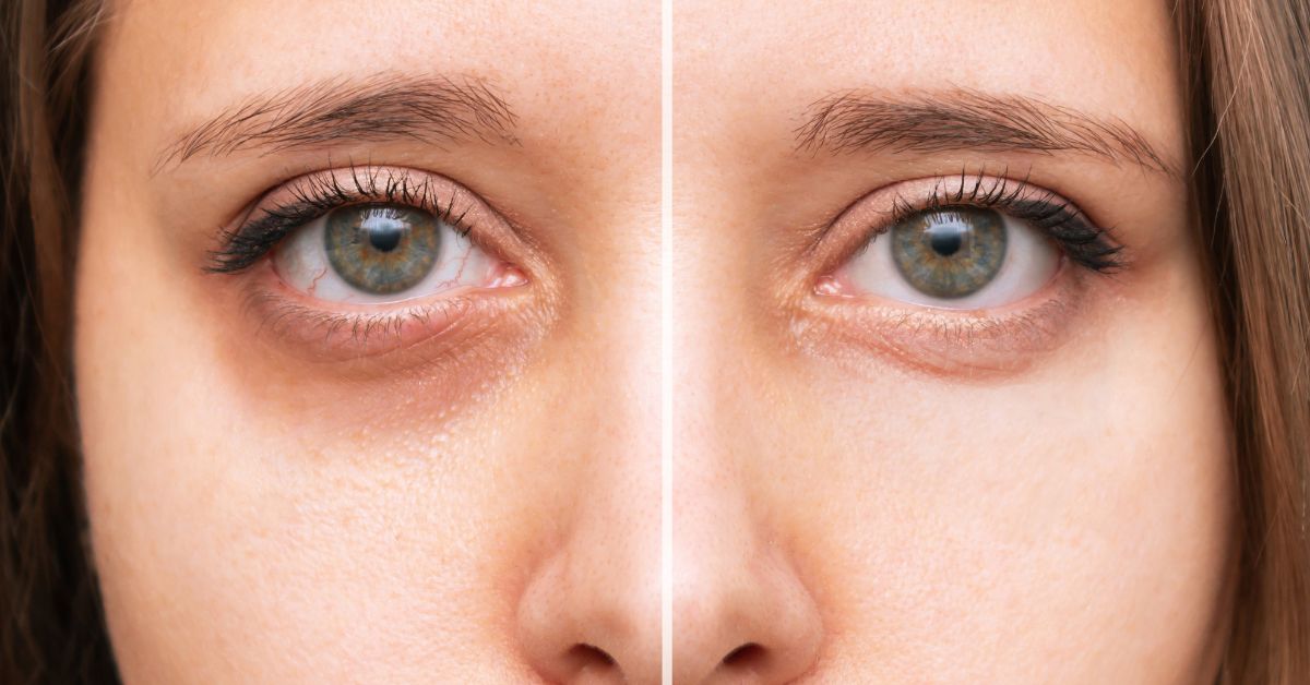 How to Hide Dark Circles Under Eyes: What You Need to Know