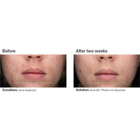 PCA Skin Acne Gel with OmniSome® - Totality Skincare