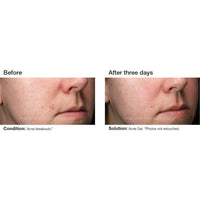 PCA Skin Acne Gel with OmniSome® - Totality Skincare