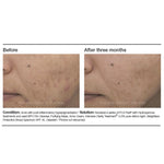 PCA Skin Acne Cream - Totality Skincare