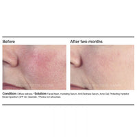 PCA Skin Anti-Redness Serum - Totality Skincare