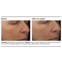 PCA Skin Intensive Age Refining Treatment® - Totality Skincare