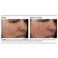 PCA Skin Intensive Age Refining Treatment® - Totality Skincare