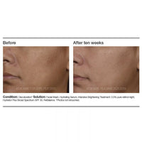 PCA Skin Intensive Brightening Treatment - Totality Skincare