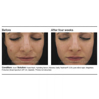 PCA Skin Intensive Clarity Treatment® - Totality Skincare