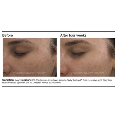 PCA Skin Intensive Clarity Treatment® - Totality Skincare
