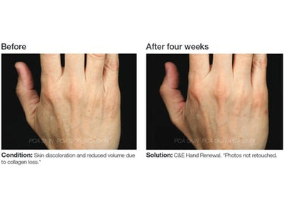 PCA Skin C&E Hand Renewal - Totality Skincare