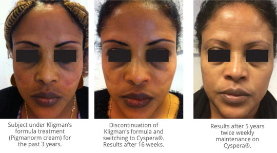 Scientis Cyspera Intesive Pigment Corrector - Totality Medispa and Skincare