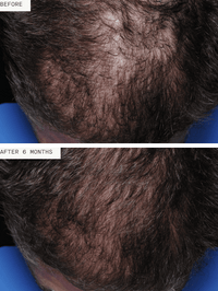 Nutrafol Men - Totality Skincare