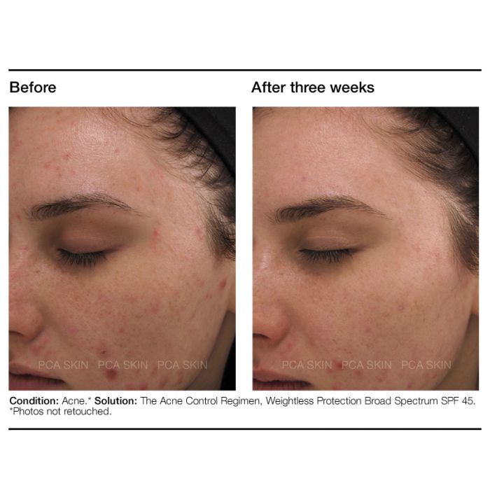 PCA Skin The Acne Control Regimen:  Acne Gel Trial, BPO 5% Cleanser, Intensive Clarity Treatment, Clearskin - Totality Skincare